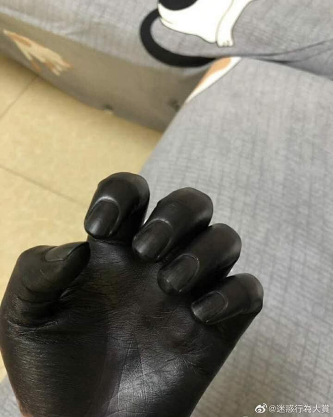 Đôi tay đen phát sợ của người đàn ông, lý do đằng sau khiến ai cũng ngao ngán-2