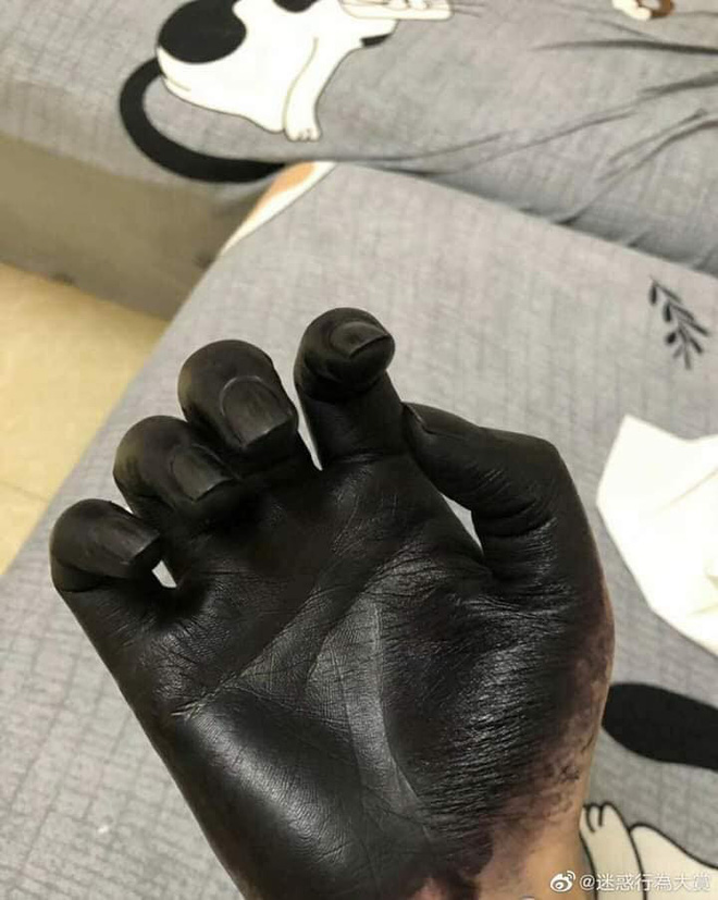 Đôi tay đen phát sợ của người đàn ông, lý do đằng sau khiến ai cũng ngao ngán-3