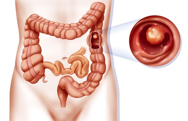 Bác sĩ khuyến cáo: Những dấu hiệu cảnh báo có thể là ung thư, nên chú ý đi khám sớm-2