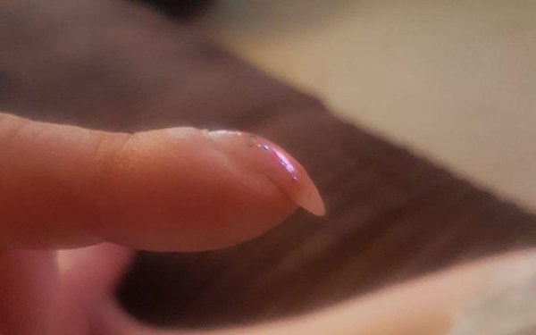 Nếu ngón tay xuất hiện những dấu hiệu này, cảnh giác ngay vì có thể bạn mắc ung thư phổi-1