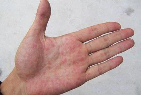 Nếu ngón tay xuất hiện những dấu hiệu này, cảnh giác ngay vì có thể bạn mắc ung thư phổi-2