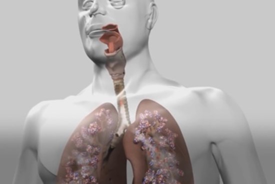 Virus corona gây tử vong ở người như thế nào?