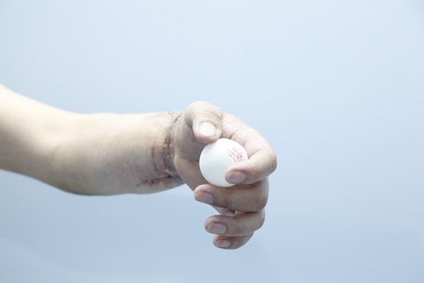 8 tiếng cân não thực hiện ca ghép chi thế giới chưa từng làm của BV Trung ương Quân đội 108-2