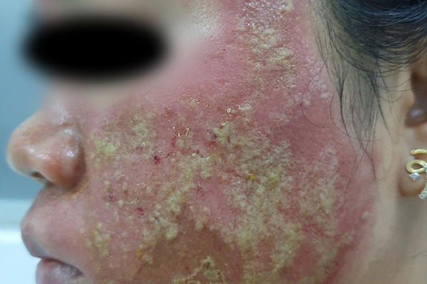 Lăn kim trị mụn lưng, người phụ nữ trẻ suýt mất mạng-2