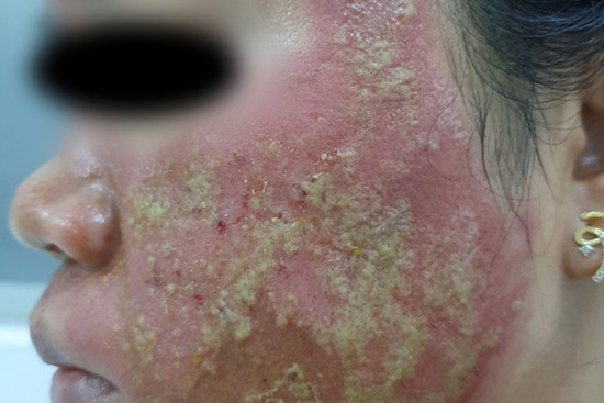 Đi lăn kim tại spa trôi nổi với giá 40 triệu đồng, người phụ nữ nhận cái kết