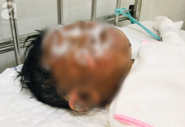 Bé trai 6 tuổi bị dì ruột tẩm xăng đốt ở Vũng Tàu phải điều trị lâu dài cả về thể xác lẫn tâm lý-2