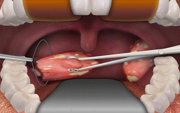 Bé gái 7 tuổi tử vong chỉ sau vài phút phẫu thuật cắt amidan, chuyên gia đưa ra một loạt cảnh báo-5