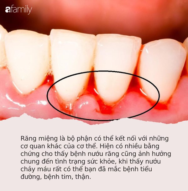 Bỗng dưng thấy răng miệng xuất hiện thứ này, đừng bỏ qua bởi có thể tim, gan, thận của bạn có thể đang gặp nguy hiểm!-2