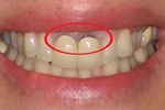 7 loại thực phẩm có thể gây tổn hại cho răng hơn cả đường mà bạn không ngờ tới: Cần lưu ý khi ăn để răng của bạn không bị tàn phá nhanh chóng-6