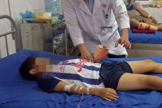 Chơi trò chơi khi điện thoại đang sạc dẫn đến nổ, bé trai 12 tuổi bị chấn thương dập nát bàn tay