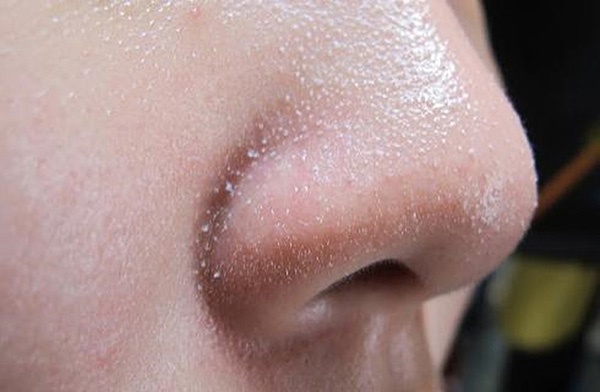 Mỗi khi rửa mặt làm điều này trong 60 giây, bạn sẽ không bao giờ bị lại mụn cám, mụn đầu đen-2