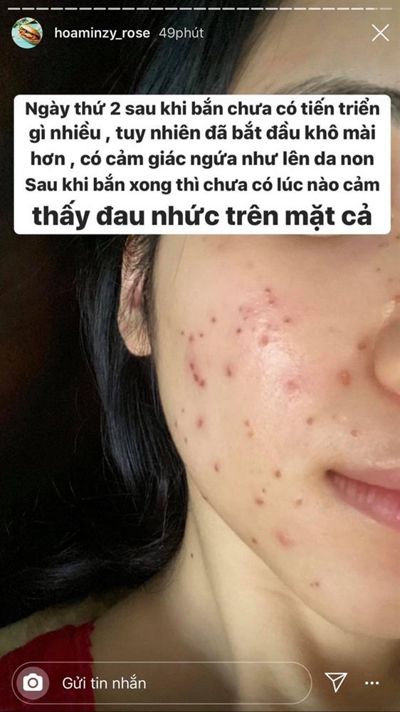 Hòa Minzy gây sốc khi để lộ gương mặt toàn nốt đỏ li ti, nhìn qua đã thấy rùng mình-2