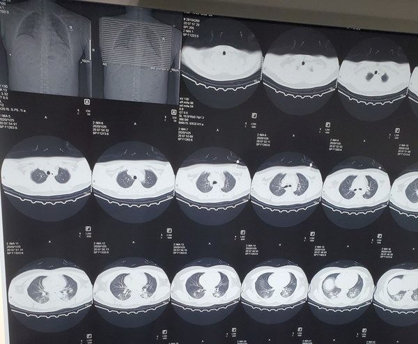 Hình ảnh phổi của bệnh nhân bị virus corona phá hủy-1