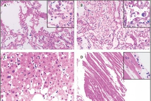 Hình ảnh phổi của bệnh nhân bị virus corona phá hủy-2