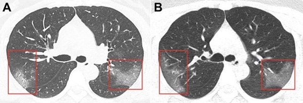 Hình ảnh phổi của bệnh nhân bị virus corona phá hủy-3