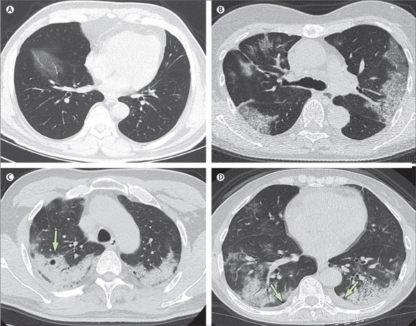 Hình ảnh phổi của bệnh nhân bị virus corona phá hủy-4