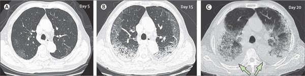 Hình ảnh phổi của bệnh nhân bị virus corona phá hủy-5