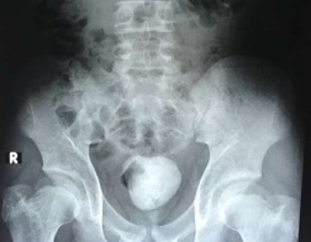 Cấp cứu thiếu niên 15 tuổi mang viên sỏi khổng lồ với kích thước 10cm ở bàng quang-1