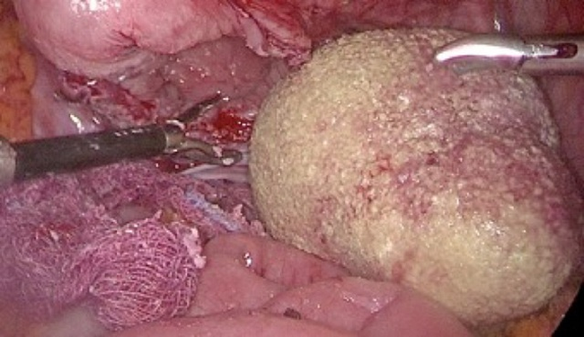 Cấp cứu thiếu niên 15 tuổi mang viên sỏi khổng lồ với kích thước 10cm ở bàng quang-2