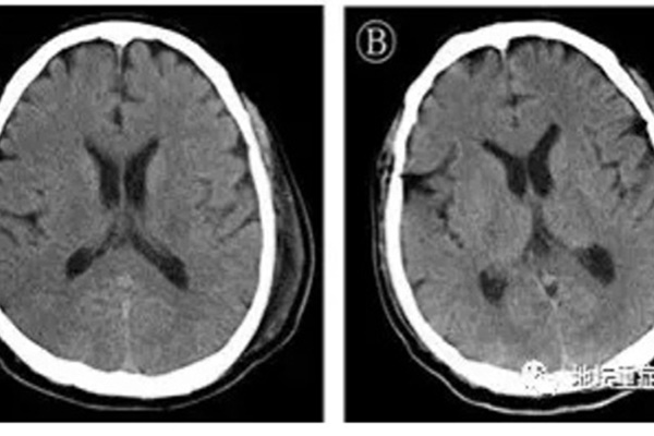 Lần đầu tiên phát hiện virus corona trong dịch não tủy của bệnh nhân-1
