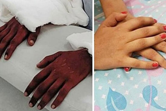 Cô gái trẻ được ghép bàn tay của một nam thanh niên da đen, 2 năm sau bác sĩ kinh ngạc khi thấy nó