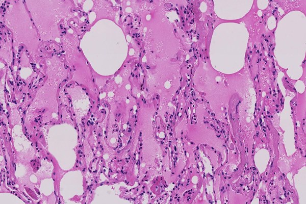 Quá trình xâm nhập và gây bệnh cho cơ thể của virus corona-2