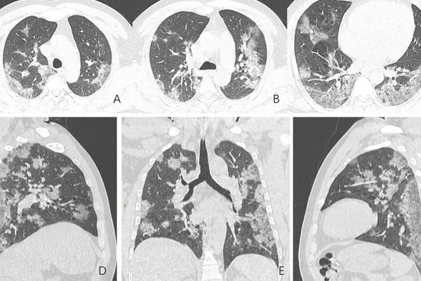 Mảng trắng bất thường trên ảnh chụp CT phổi của bệnh nhân Covid-19-1