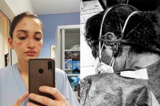 'Biểu tượng' chống Covid-19 ở Italy: Nữ y tá ngủ gục trên bàn, mặt đầy vết bầm vì đeo khẩu trang sau 10 tiếng đồng hồ làm việc không nghỉ