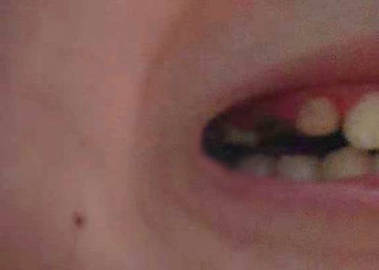 Đang nằm nhà nhai kẹo ôn lại tuổi thơ, cô gái bỗng thấy trong miệng có gió lùa vì rụng một lúc 3 chiếc răng-3