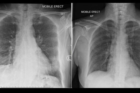 Phát hiện cách hệ miễn dịch chống lại virus Corona