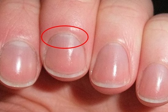 4 dấu hiệu lạ trên tay có thể là dấu hiệu cảnh báo thận của bạn có thể đang suy yếu, cần theo dõi thêm để bảo vệ sức khỏe