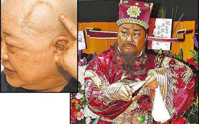 Sau 3 lần suýt chết, phải mổ khối u não 10 cm, sức khỏe của Bao Thanh Thiên hiện ra sao?-5