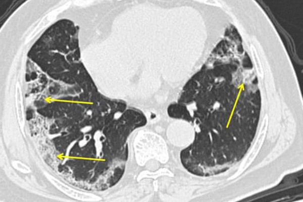 Không giống viêm phổi thông thường: Điều gì xảy ra với phổi của bệnh nhân nhiễm COVID-19?-1