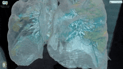 Đoạn video cho thấy virus corona có thể làm gì với phổi của bệnh nhân: Tất cả mọi người, xin hãy chống dịch thật nghiêm túc-1