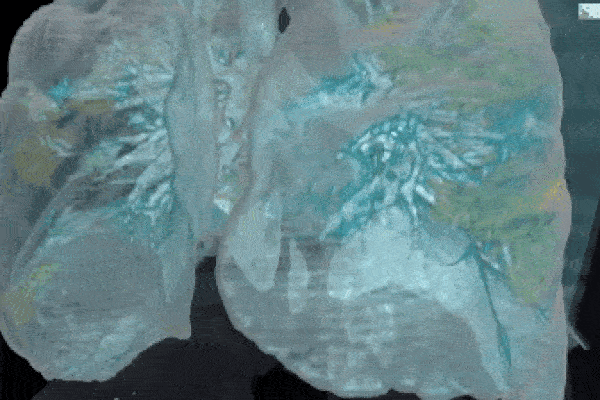 Đoạn video cho thấy virus corona có thể làm gì với phổi của bệnh nhân: Tất cả mọi người, xin hãy chống dịch thật nghiêm túc