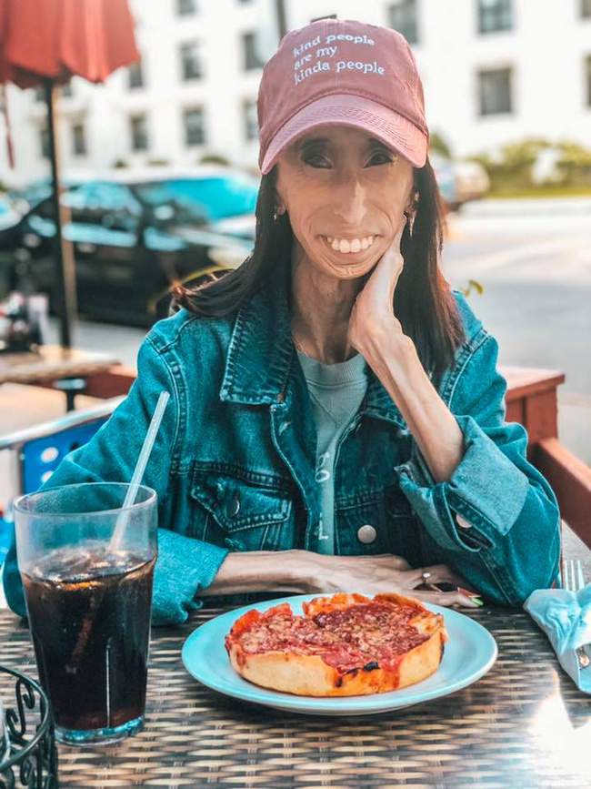 Sinh ra với diện mạo khác biệt, cô gái bị bắt nạt suốt cả tuổi thơ và sự thay đổi nhiều năm sau khiến mọi người ngỡ ngàng-3