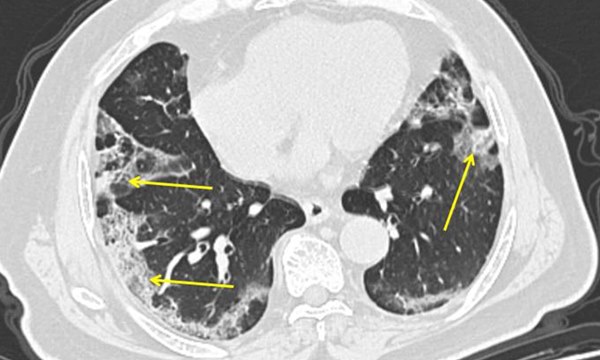 Virus corona len lỏi trong cơ thể bệnh nhân như thế nào?-1