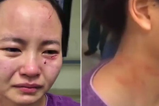 Nữ y tá bật khóc nức nở với gương mặt trầy xước, dính máu khi bị bệnh nhân nhiễm Covid-19 trong khu cách ly tấn công, từ chối điều trị