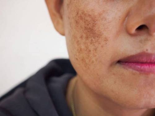 Sống chung với nám bao năm là vì bạn chưa biết đến 5 loại mặt nạ trị nám này thôi-1