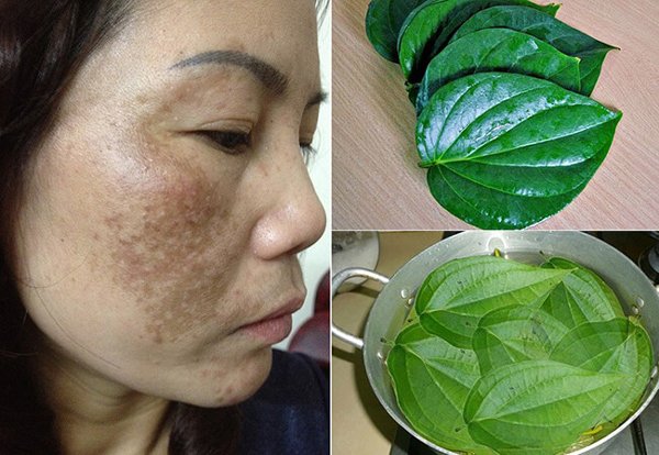 Sống chung với nám bao năm là vì bạn chưa biết đến 5 loại mặt nạ trị nám này thôi-2