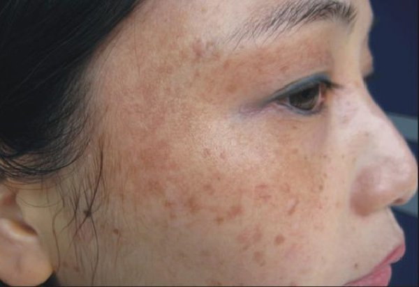 Sống chung với nám bao năm là vì bạn chưa biết đến 5 loại mặt nạ trị nám này thôi-7