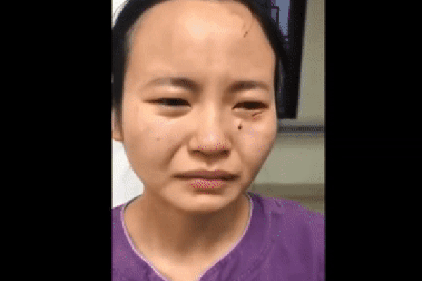 Nữ y tá bị bệnh nhân nhiễm virus đánh đập, cắn vào mặt