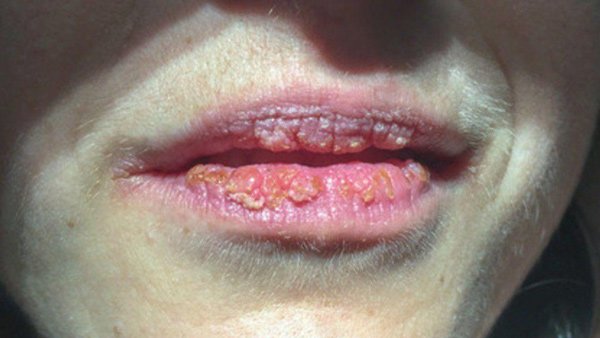 Chị em cẩn trọng khi thấy điều này trên môi, cảnh báo nguy cơ ung thư vú rất cao-1