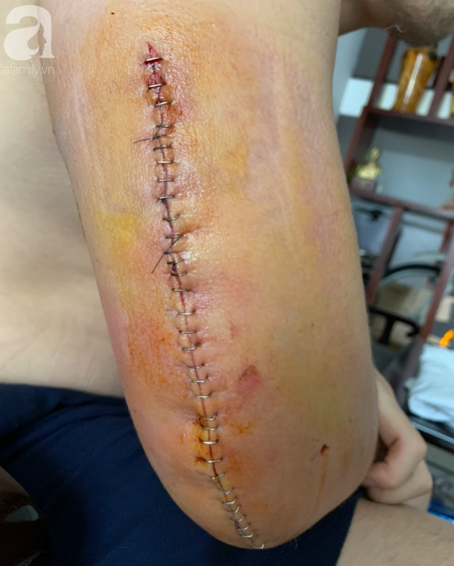 TP.HCM: Vật tay đùa giỡn với bạn, chàng trai 25 tuổi suýt tàn phế vì tai nạn kinh hoàng-3