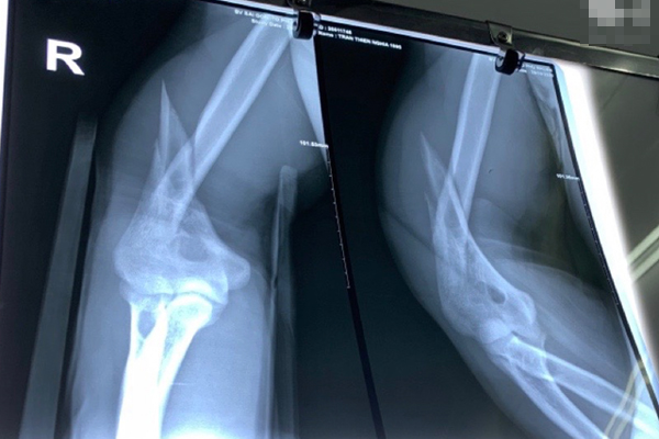 Cô gái 20 tuổi mất thính lực tạm thời do làm 1 việc mà rất nhiều người vẫn hay làm sau khi tắm-3