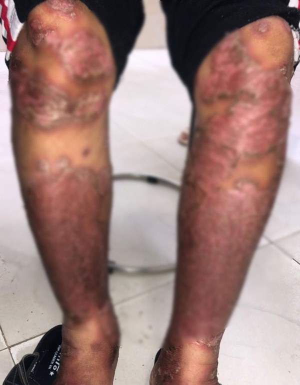 Bôi thuốc nam dân tộc Dao chữa vảy nến, người phụ nữ lãnh hậu quả sưng phù, lở loét nặng nề cơ thể-1