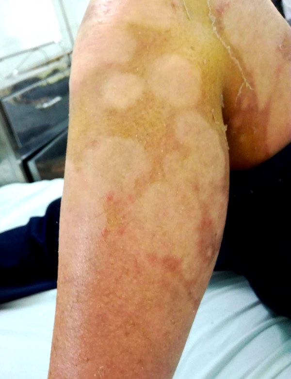 Bôi thuốc nam dân tộc Dao chữa vảy nến, người phụ nữ lãnh hậu quả sưng phù, lở loét nặng nề cơ thể-2