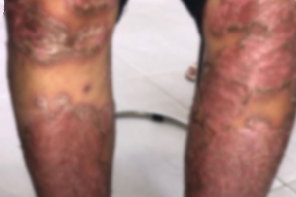 Mua thuốc trị vảy nến trên mạng giá 200 ngàn đồng, người đàn ông ở Đắk Lắk bị sưng phù đau nhức khủng khiếp-3