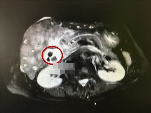 Người phụ nữ nhập viện do ung thư, hóa ra thủ phạm” gây bệnh đã nằm trong cơ thể suốt 40 năm mà không hề biết-2