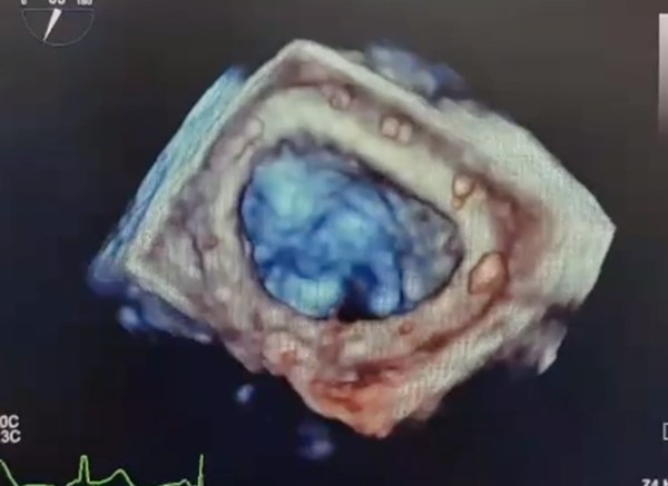 Hoàn toàn khỏe mạnh chỉ xuất hiện sốt, ăn uống kém bệnh nhân không ngờ bị một bệnh lý vô cùng phức tạp-2